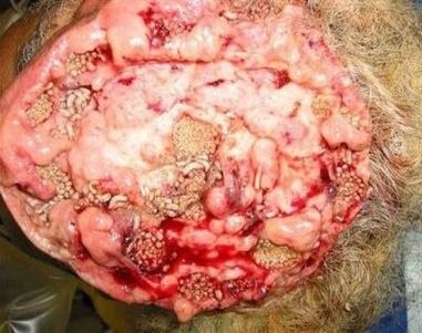 παράσιτα στον ανθρώπινο εγκέφαλο